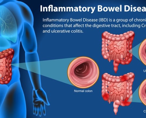 inflammatory bowl syndrome