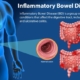 inflammatory bowl syndrome