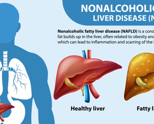 Nonalcoholic Fatty Liver Disease (NAFLD) illustration