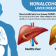 Nonalcoholic Fatty Liver Disease (NAFLD) illustration