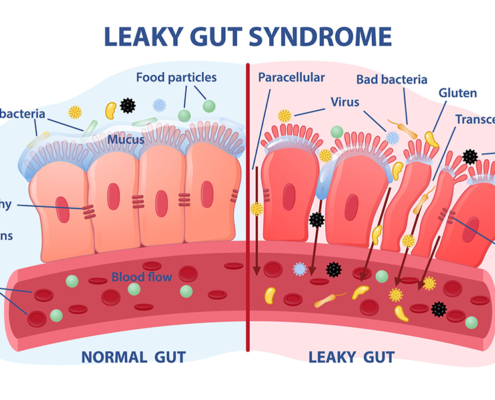 diagram explaining leaky gut syndrome