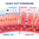 diagram explaining leaky gut syndrome