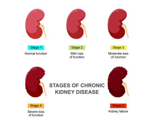 kidney disease graphic