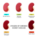 kidney disease graphic