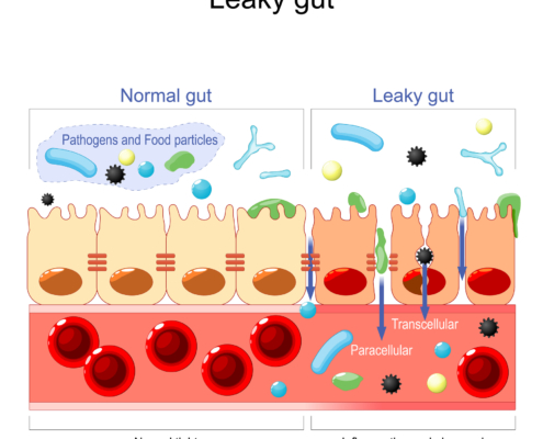 Leaky Gut